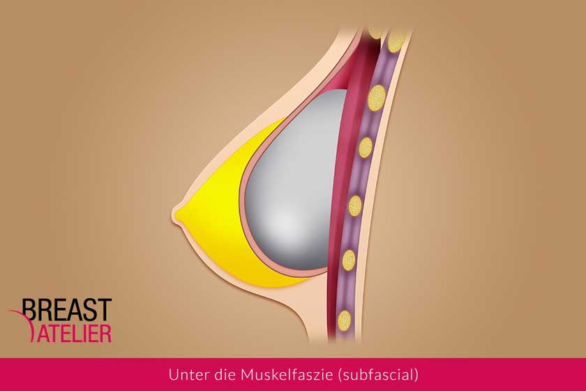 Einsetzen des Implantates zwischen den Brustmuskel und die Muskelfaszie