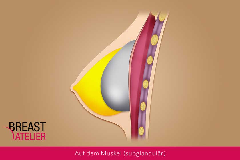 Implantat auf dem Brustmuskel