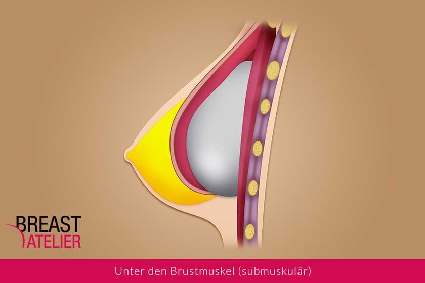 Einsetzen des Implantates unter dem Brustmuskel