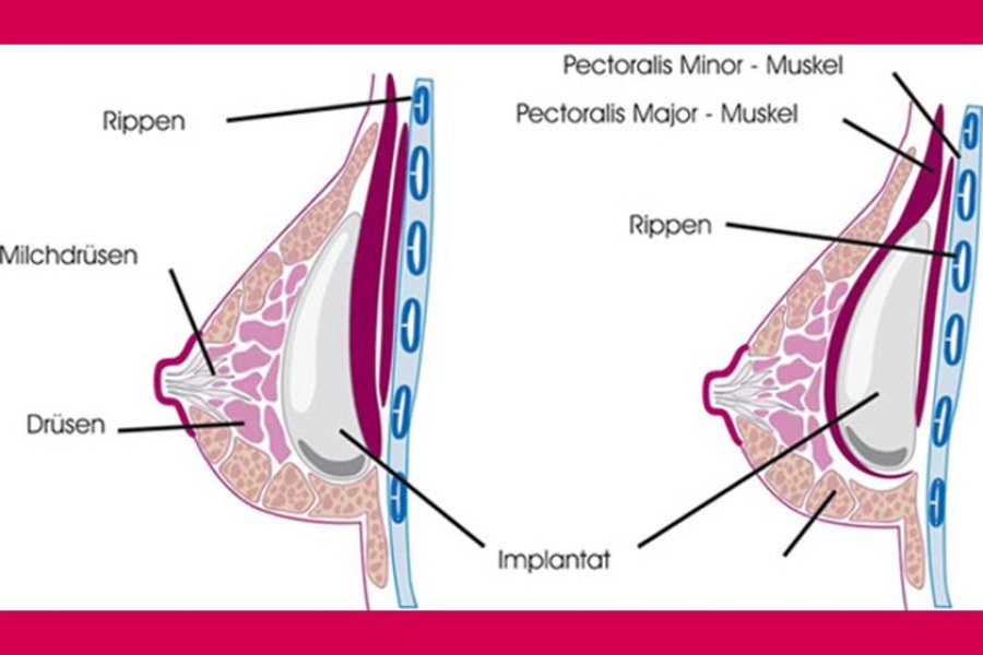 Platzierung der Implantate