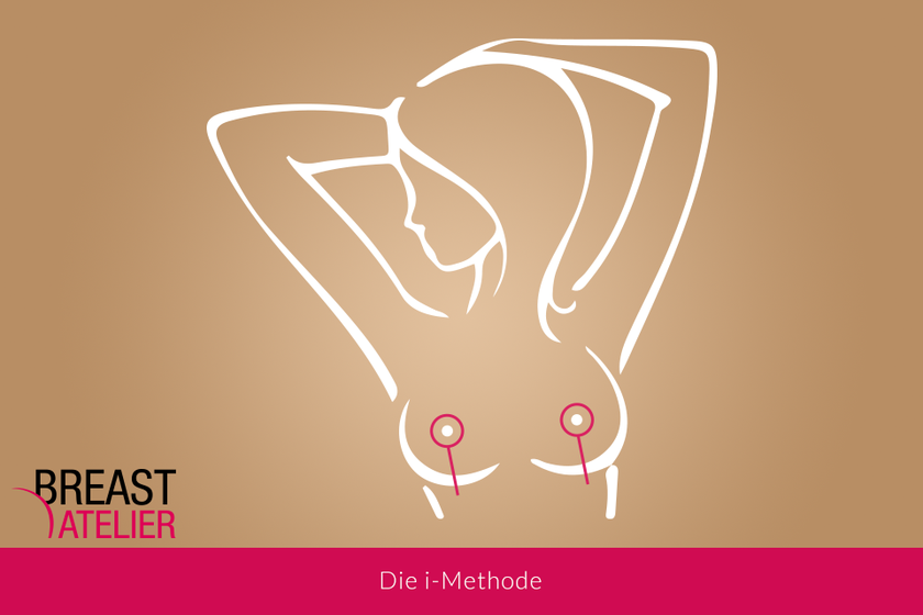 Breast surgery i-method