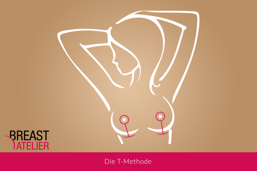 Method_T