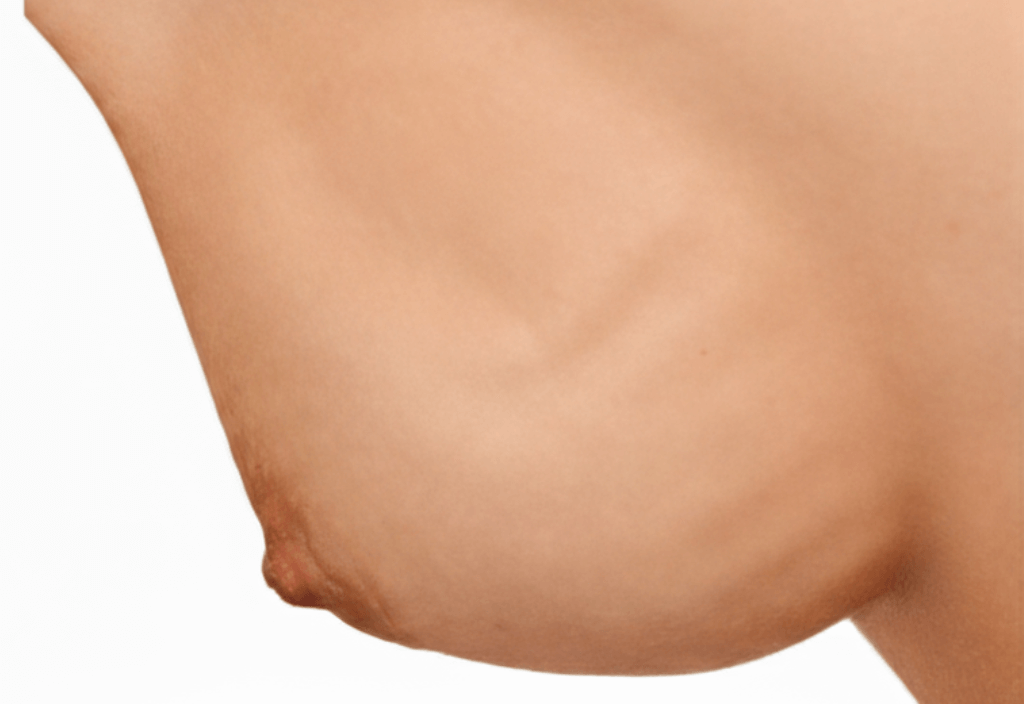 brustvergroesserung-rippling-expertenbericht-breast-atelier-zuerich