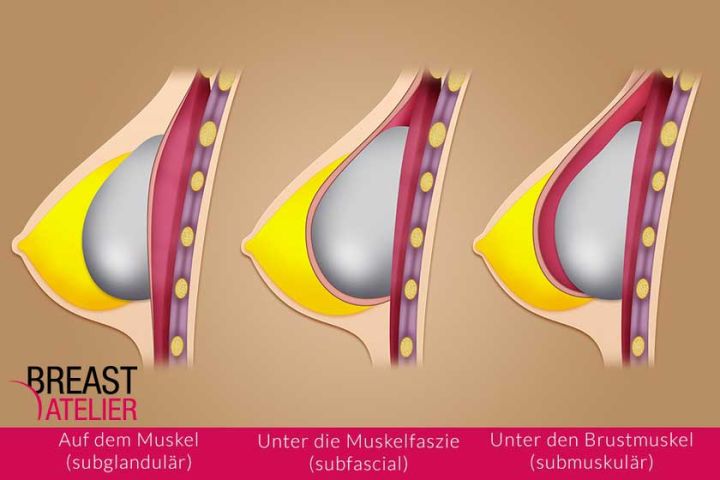 Die Brustvergrösserung: Wo wird das Implantat eingesetzt?