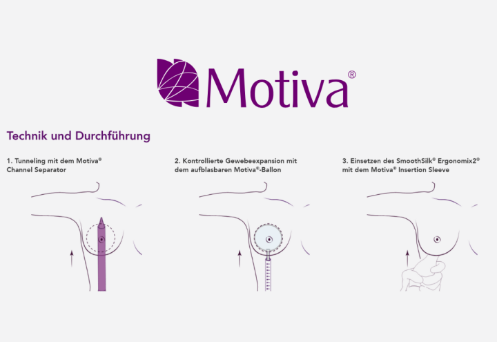 Neu bei uns: Motiva Preservé™ – die nächste Generation der Brustvergrösserung