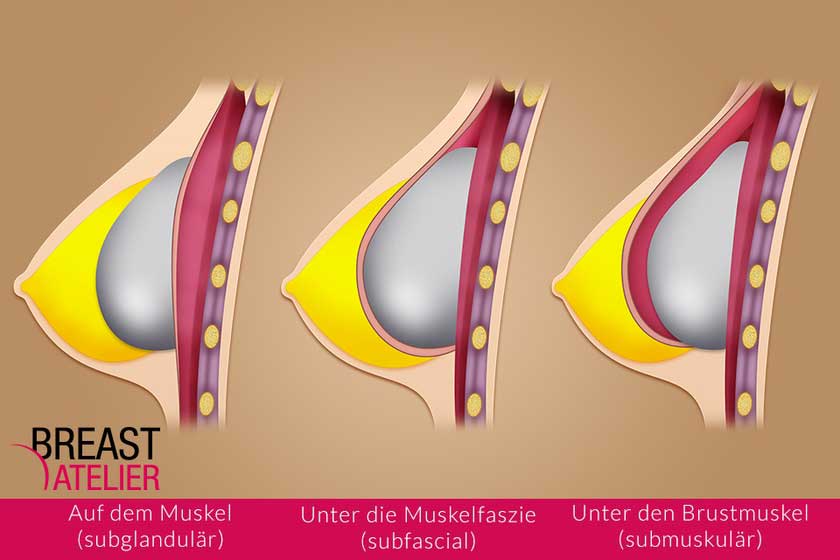 Die Brustvergrösserung: Wie wird das Implantat eingesetzt?